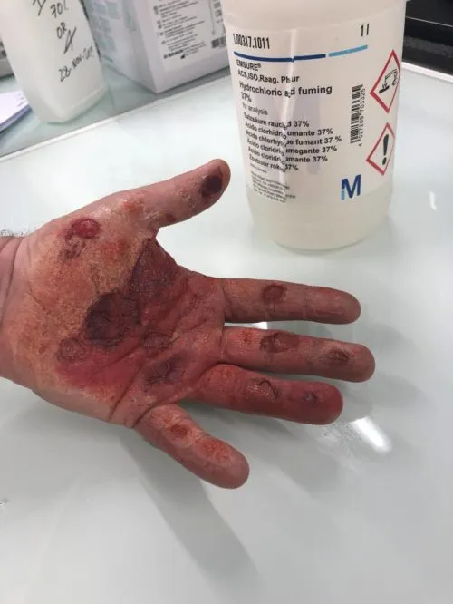 Hand burn - employee contamination due to a chemical risk