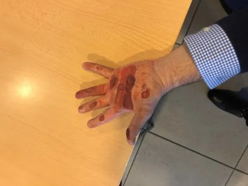 Hand burn due to a chemical risk