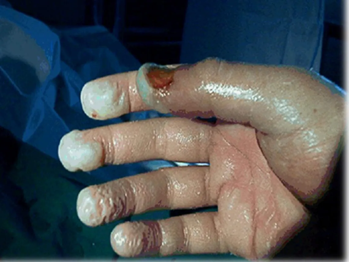 hand chemical burn